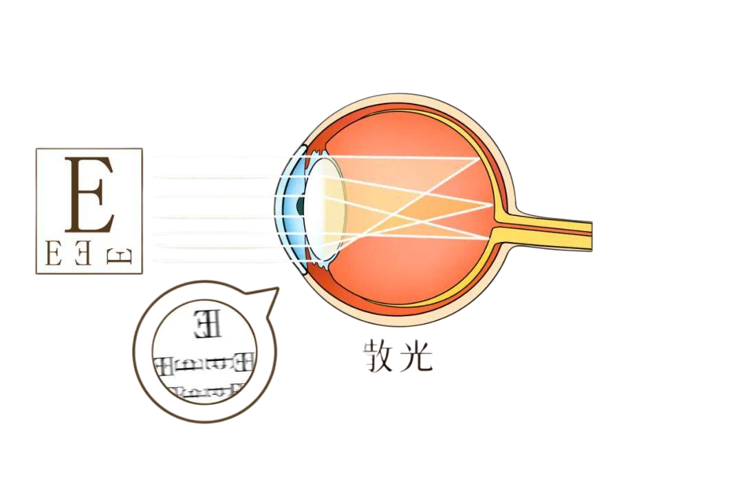 为什么近视的人普遍有散光 关于散光,这4件事你一定要知道